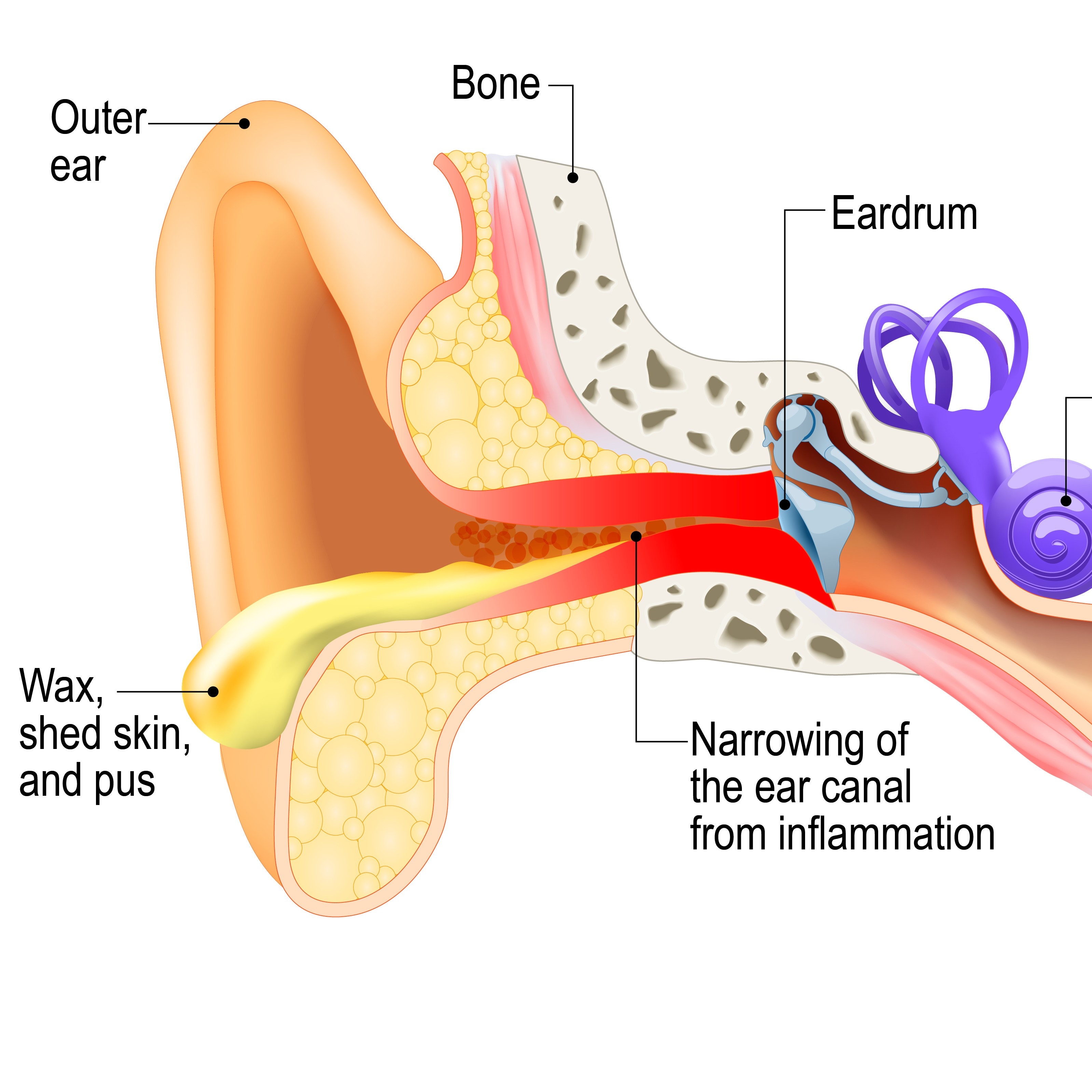This illustration, depicting both the outer and inner ear, shows how the infection from swimmer's ear has narrowed the ear canal.