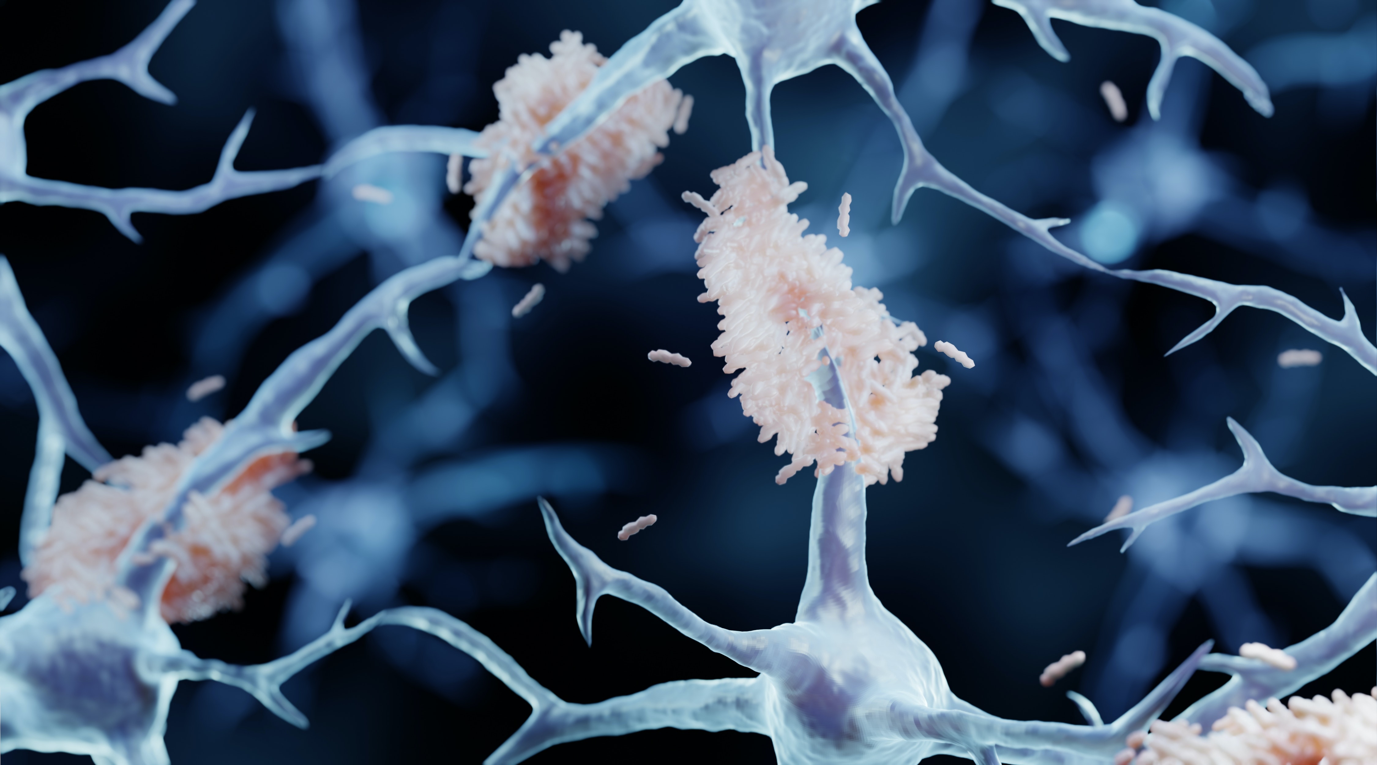 Alzheimer's disease illustration showing misfolded proteins called plaques that aggregate between nerve cells in people with Alzheimer's.