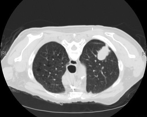 CT scan of lung adenocarcinoma