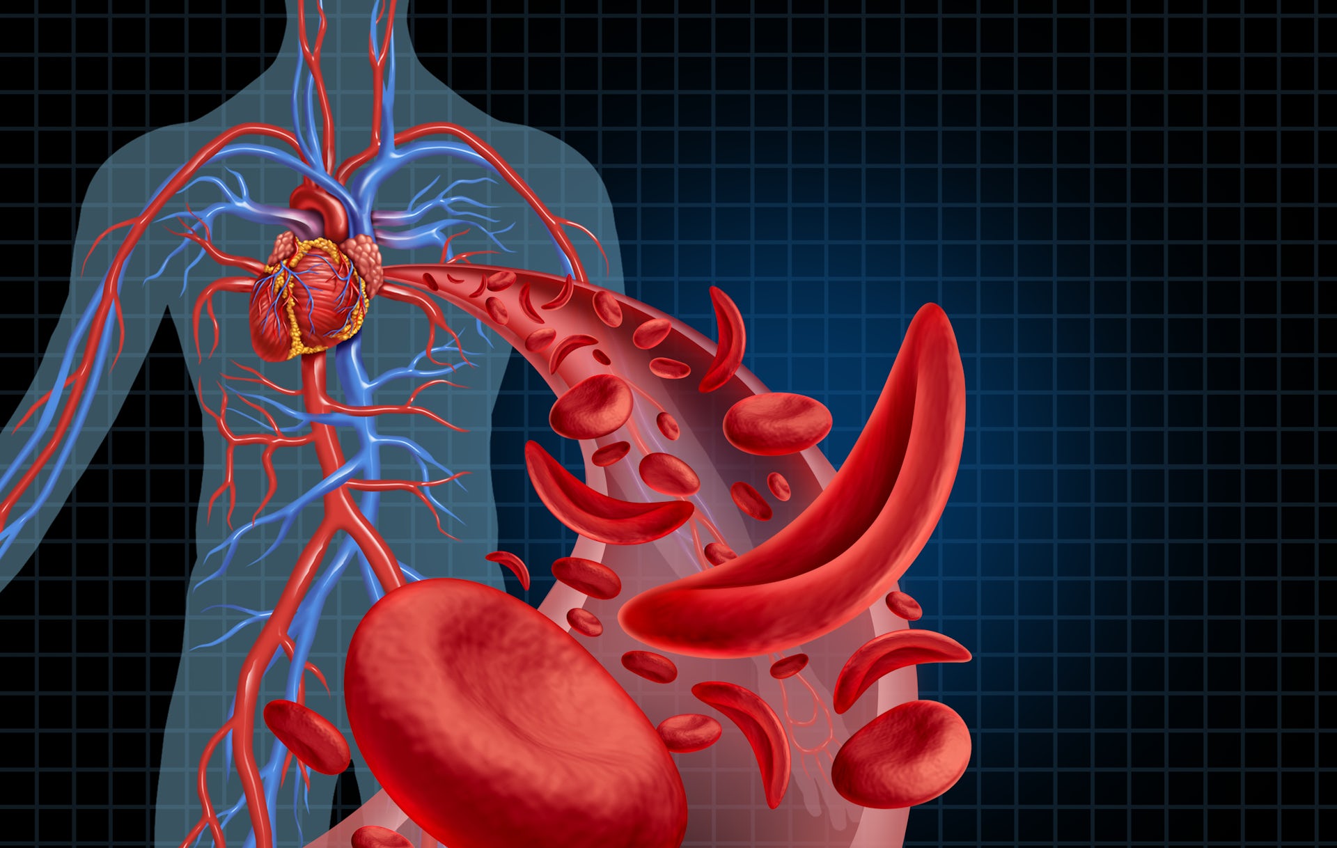 Three-dimensional illustration of human artery anatomy, showing normal red blood cells and sickle-shaped blood cells flowing away from the heart.